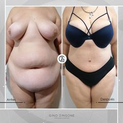 Abdominoplastia - Dr. Gino Zingone