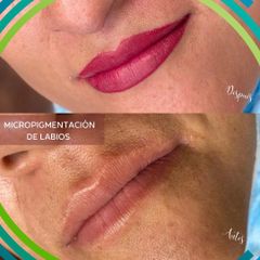 Micropigmentación - Dermatodesign