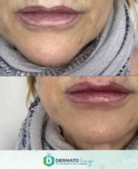 Aumento de labios - DERMATOdesign