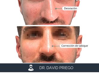 Rinoplastia antes y después - 881213