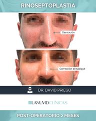 Rinoseptoplastia