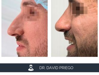 Rinoplastia antes y después - 881214