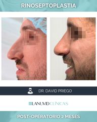 Rinoseptoplastia