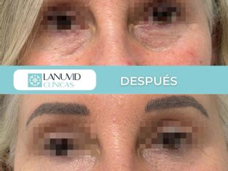 Eliminación ojeras antes y después - 881215