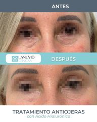 Tratamiento antiojeras con ácido hialurónico