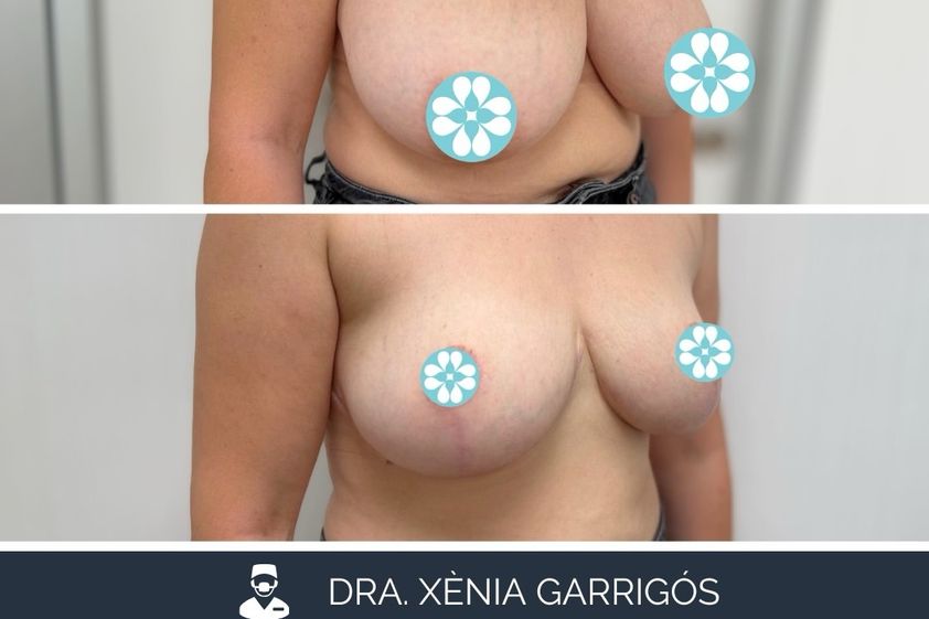 Reducción senos antes y después - 881220
