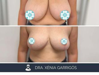 Reducción senos antes y después - 881221