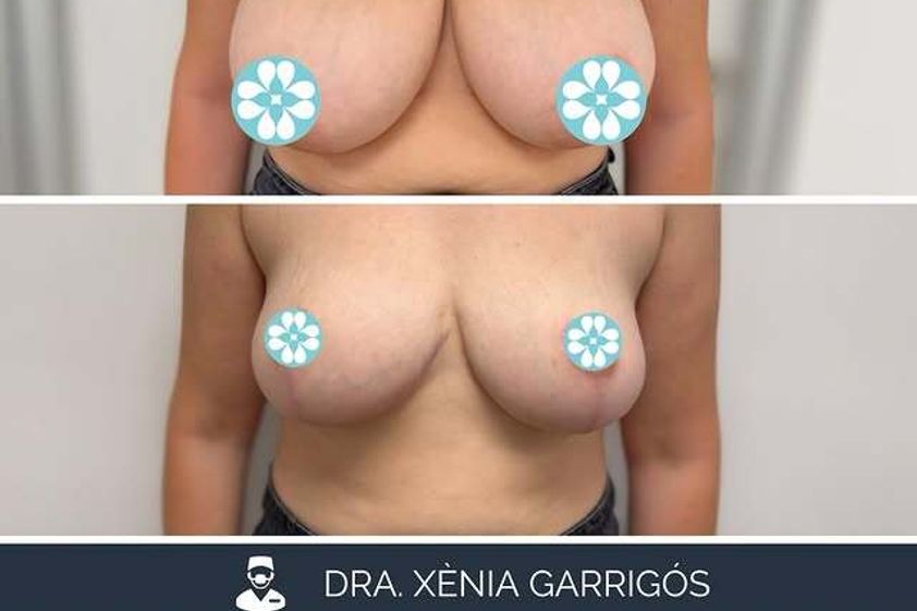 Reducción senos antes y después - 881221