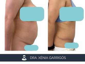 Abdominoplastia antes y después - 881224