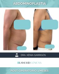 Abdominoplastia