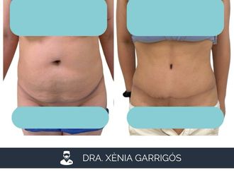 Abdominoplastia antes y después - 881225