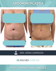Abdominoplastia
