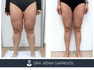 Lipedema antes y después - 881226