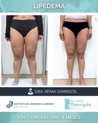 Lipedema