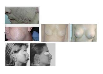 Genidental Laser