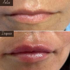 Aumento de labios - Aura Norte
