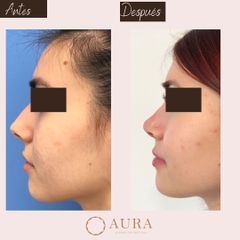 Rinoplastia - Aura Norte