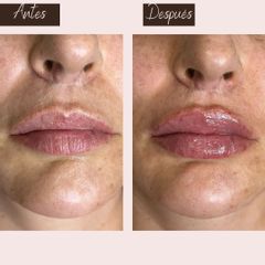 Aumento de labios - Aura Norte