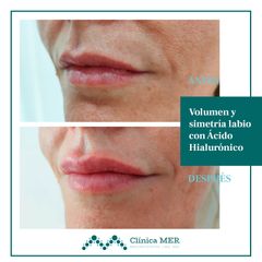 Aumento de volumen en labios - Clínica MER