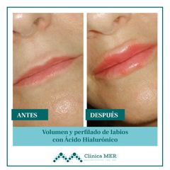 Aumento de volumen en labios - Clínica MER