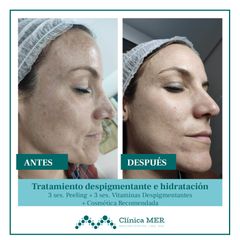 Despigmentante e hidratación facial - Clínica MER