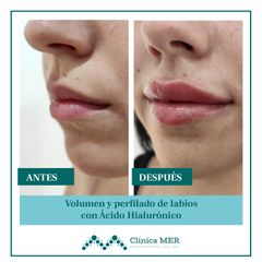 Aumento de labios - Clínica MER