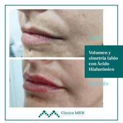 Aumento de labios - Clínica MER