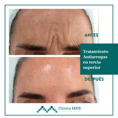 Antiarrugas frente - Clínica MER