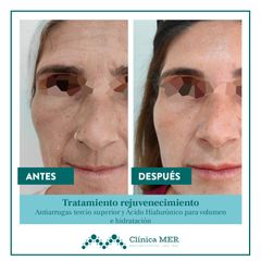 Rejuvenecimiento facial integral - Clínica MER