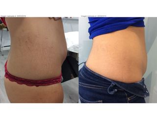 Antes y después tratamiento estrias 
