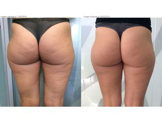 Antes y después tratamiento celulitis