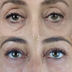 Antes y después Rejuvenecimiento de la mirada con Ácido hialurónico 