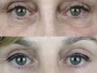 Radiofrecuencia facial - 661867