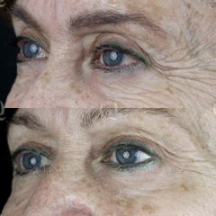 Antes y después Elevación cejas sin cirugía mediante microinyecciones de ácido hialurónico