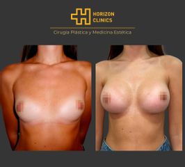 Aumento de pecho - Horizon Clinics