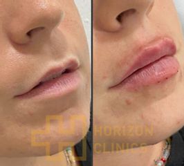 Aumento de labios - Horizon Clinics