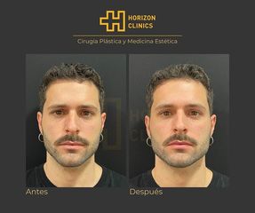 Masculinización facial - Horizon Clinics