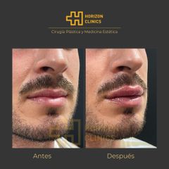 Aumento de labios - Horizon Clinics