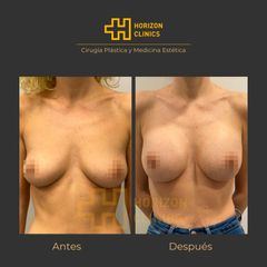 Aumento de pecho - Horizon Clinics