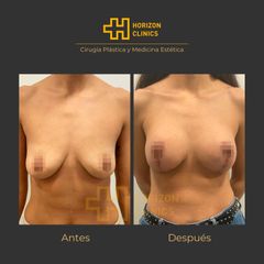 Mastopexia - Horizon Clinics