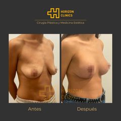Mastopexia - Horizon Clinics