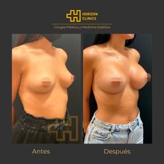 Aumento de pecho - Horizon Clinics