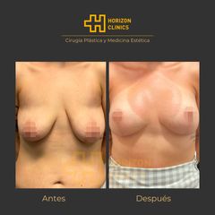 Mastopexia - Horizon Clinics