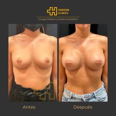 Aumento de pecho - Horizon Clinics