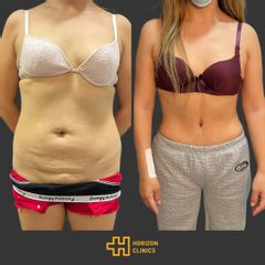 Abdominoplastia - Horizon Clinics