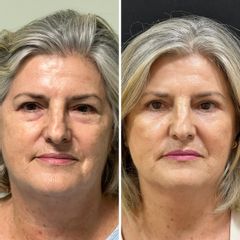 Blefaroplastia - Horizon Clinics