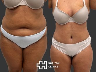 Abdominoplastia antes y después - 872706