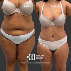 Abdominoplastia