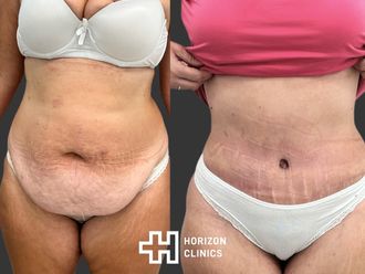 Abdominoplastia antes y después - 872707