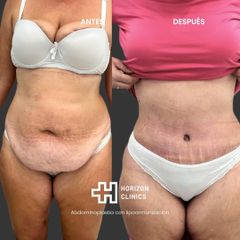 Abdominoplastia